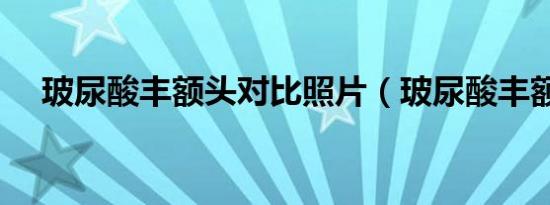 玻尿酸丰额头对比照片（玻尿酸丰额头）